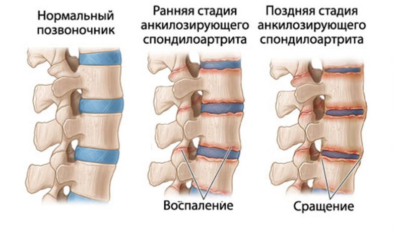 Фото - Сибирские ученые создадут тест-системы для ранней диагностики заболевания позвоночника